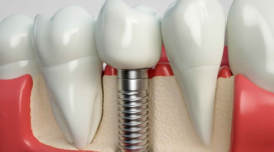 Quién pone los implantes dentales